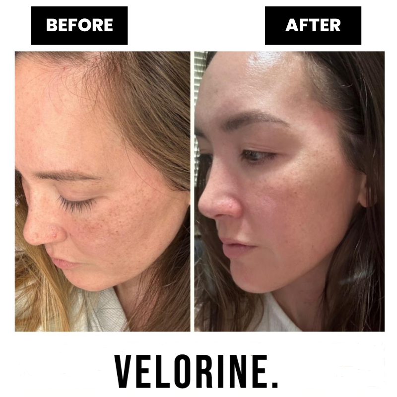 Velorine™ Dark Spots Removal Cream